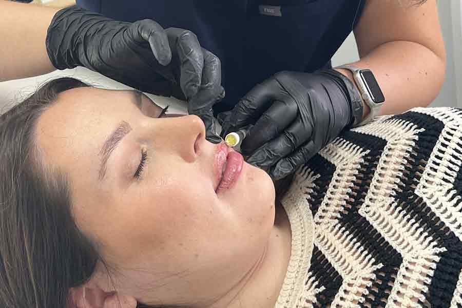 woman receiving an dermal filler injection in her lip